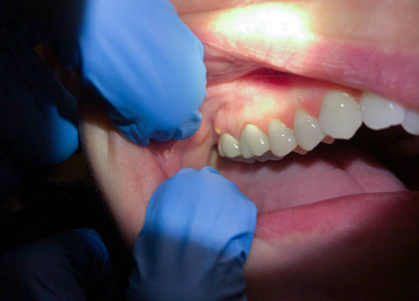 Best Emergency Wisdom Teeth Removal in La Cresta, CA
